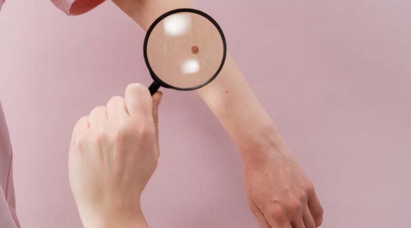 Controllo melanoma, foto da Pexels